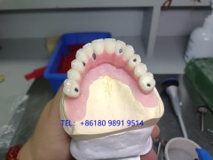 深圳种植牙厂家 深圳种植牙加工厂 种植牙出口外贸图4